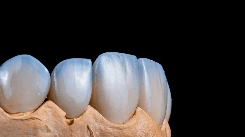 bone graft for dental implant