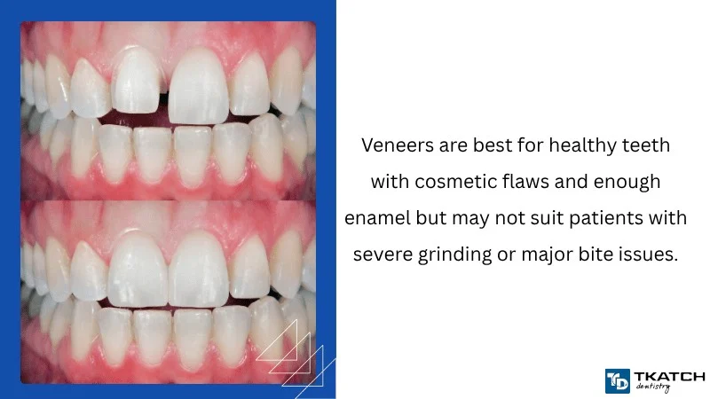 Who Should Choose Veneers
