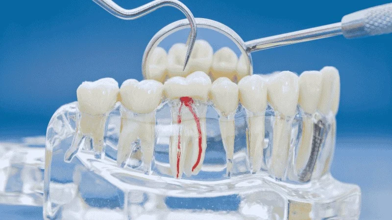 delaying root canal treatment
